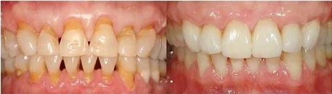 Antes e depois