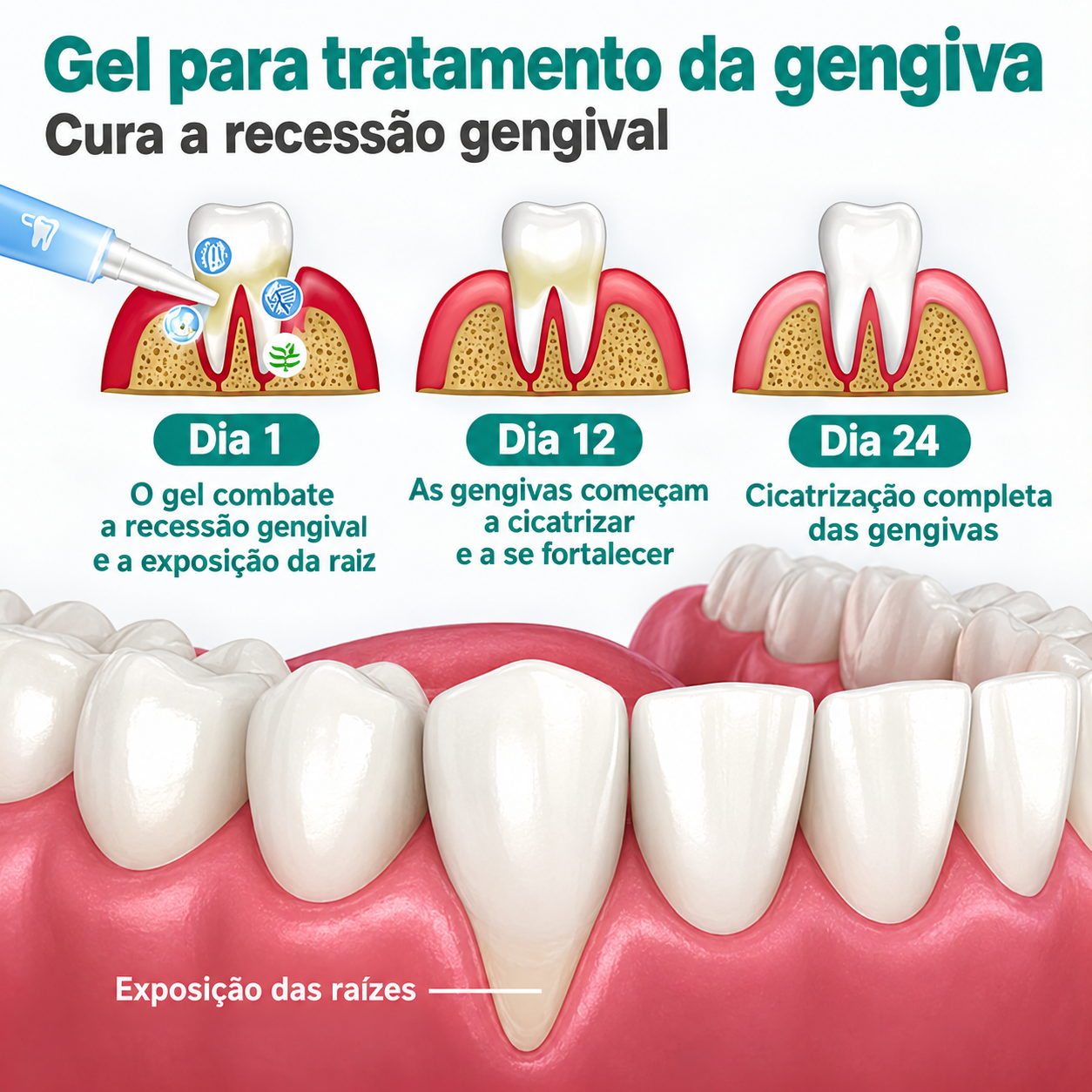 Gel para tratamento gengival — Dia 1, 12 e 24