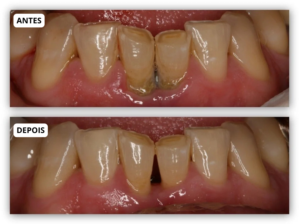 Antes e depois
