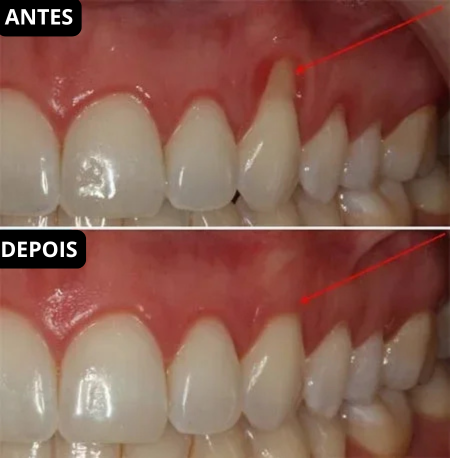Antes e depois