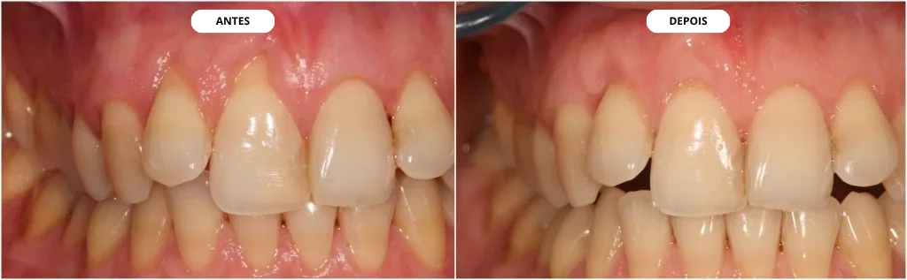 Antes e depois