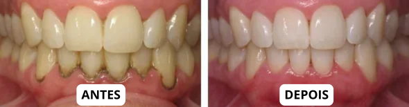 Antes e depois